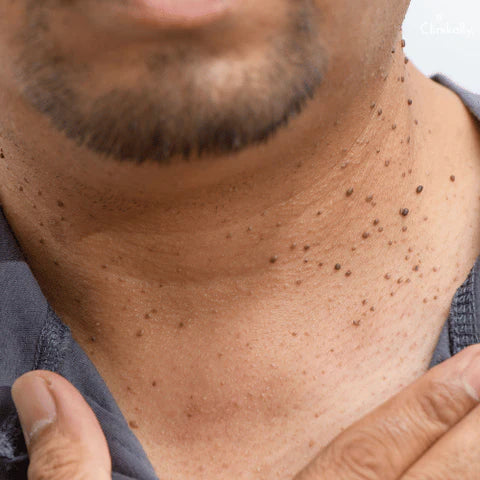 Warts Removal