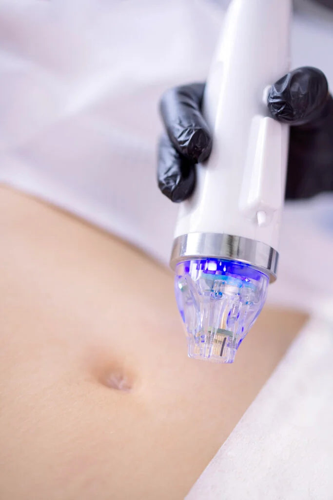 RF Microneedling & Exosomes