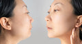 Mesolipo + RF & Cavitation
