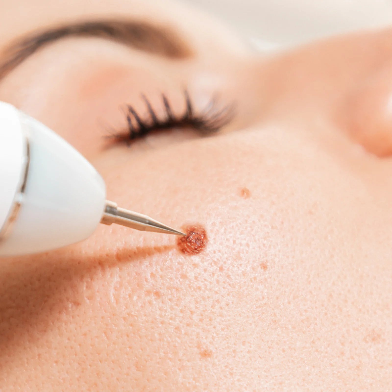 Warts Removal