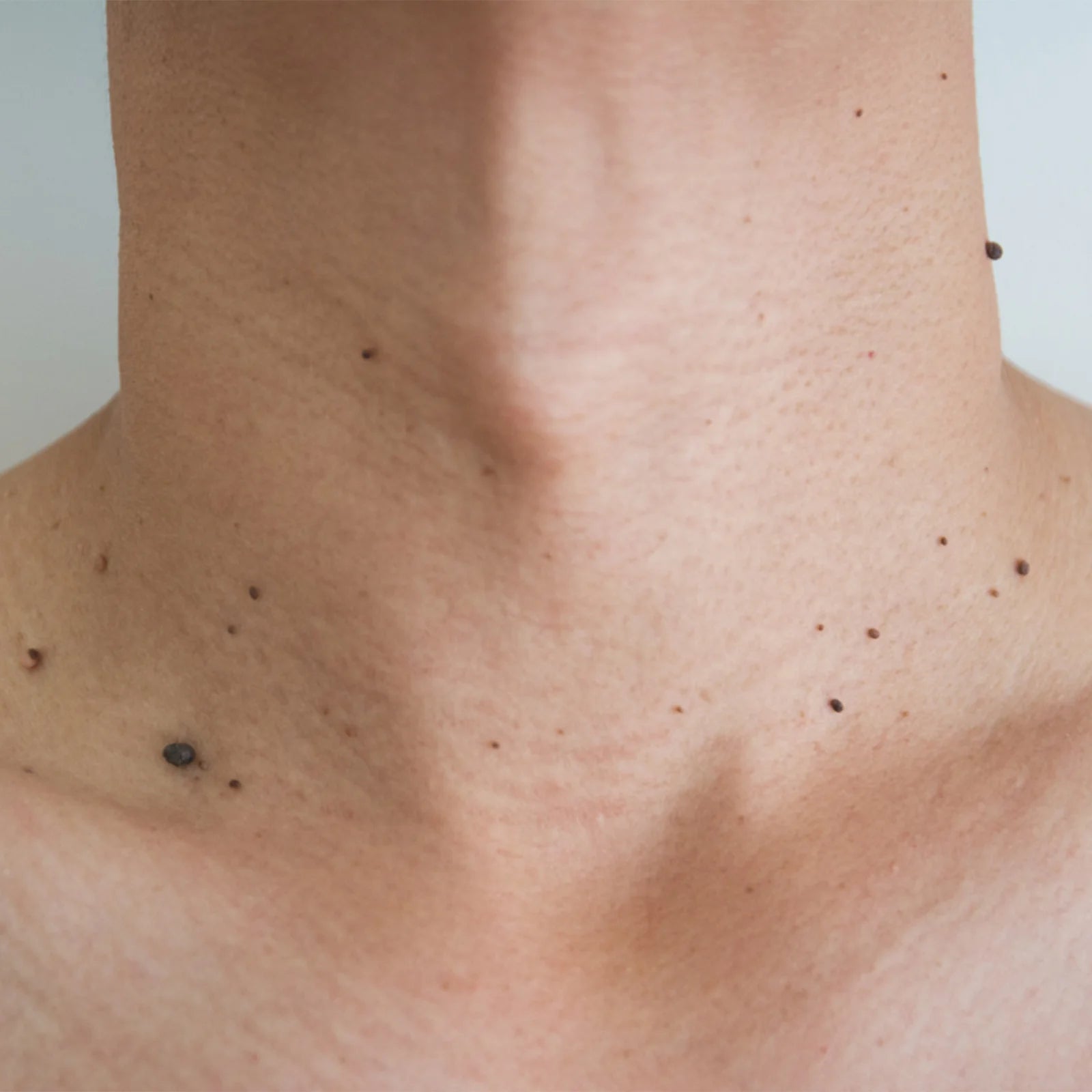 Warts Removal
