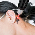 Tattoo Removal