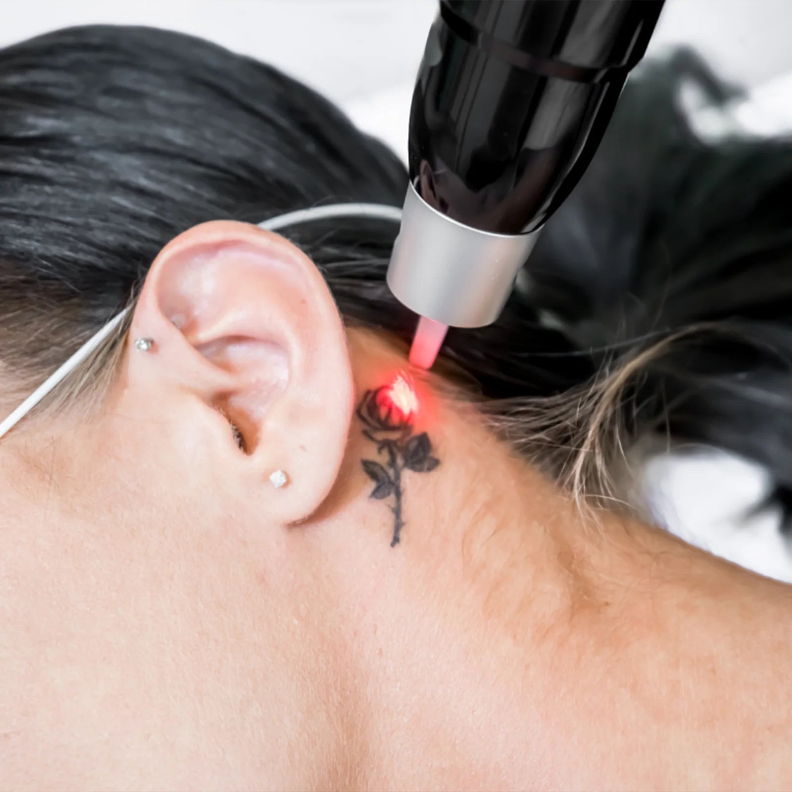Tattoo Removal