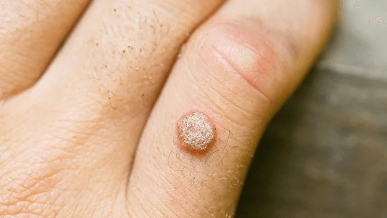 Warts Removal
